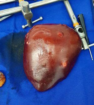 A Right Hepatectomy With Multiple Colorectal Metastases MEDizzy