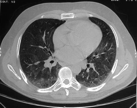 Fluid Around Lung Ct Scan 