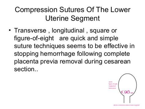 Uterine Compression Sutures