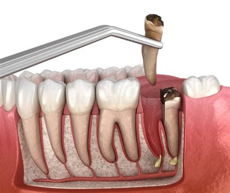 Complex Tooth Extraction Medically Accurate 3d Illustration Of Dental Treatment Stock