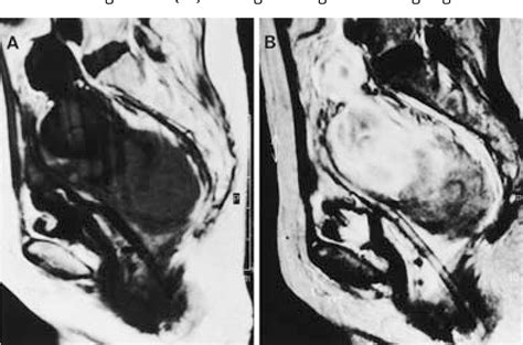 Figure 3 From A Case Report Of Spontaneous Intramural Hematoma Of The