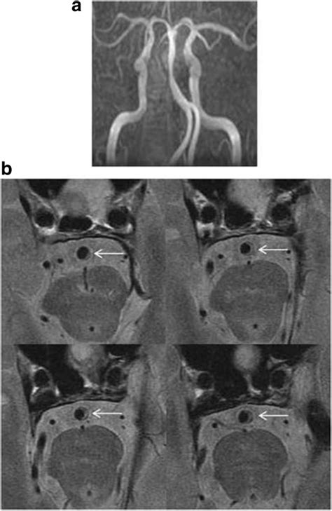 Relationship Between The Geometry Patterns Of Vertebrobasilar Artery