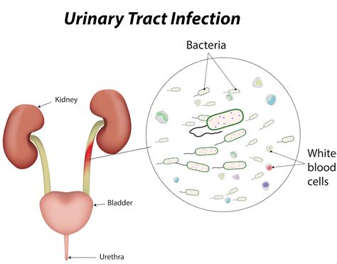 Proteus mirabilis UTI causes, symptoms, diagnosis, treatment & prognosis