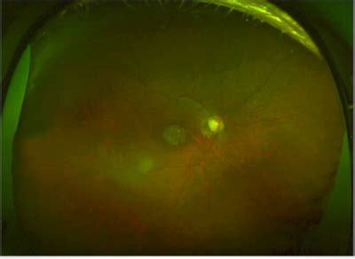 Fundus Albipunctatus With Cone Dystrophy Page Of Retina Revealed