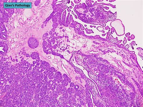 Qiao S Pathology Digital Papillary Carcinoma Microscopic Flickr