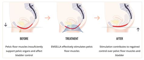 Incontinence Near Me Urinary Incontinence Cost NYC New York City