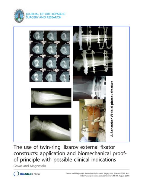 PDF The Use Of Twin Ring Ilizarov External Fixator Constructs