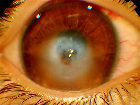 Corneal Edema Glaucoma