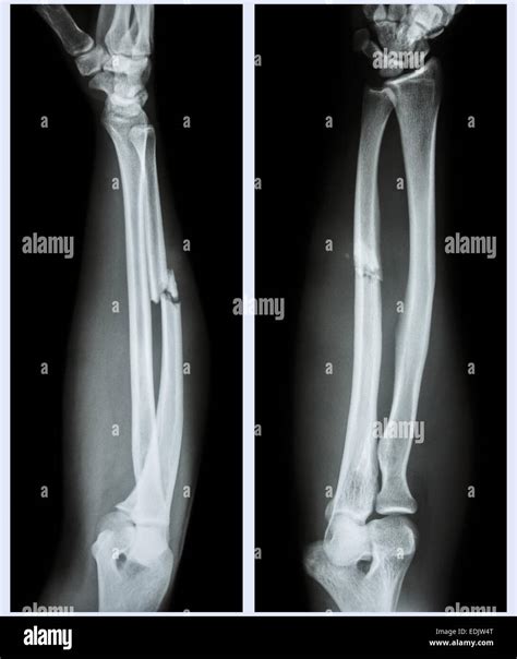 Comminuted Fracture X Ray