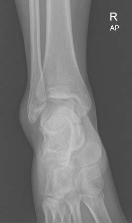 Fibular Tip Avulsion Fracture With Pseudo Jones Fracture Radiology