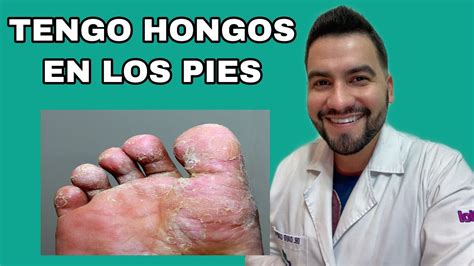 Tengo Hongos En Los Pies Tengo Pie De Atleta TiÑa Pedis Dr David