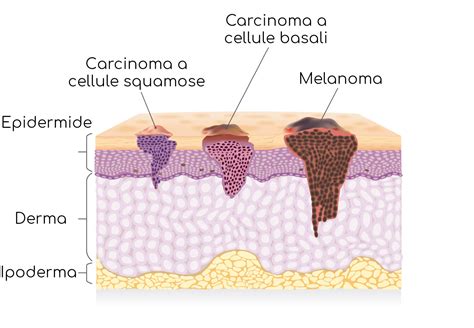 Tumori Della Pelle Immagini Cause Sintomi Sopravvivenza E Cura Valori Normali