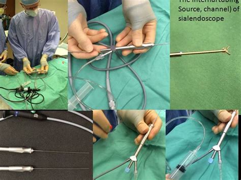 The Future of Sialendoscopy March 22 2015 LSU Sialendoscopy Course lecture | Iowa Head and Neck ...