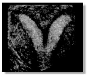 Bicornuate Uterus On 3 D