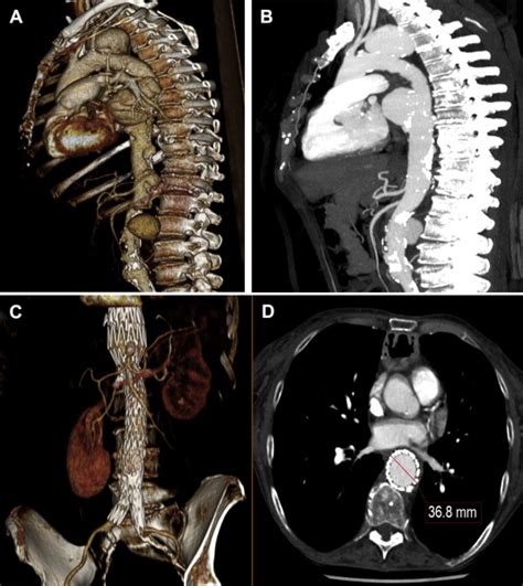 Computed Tomography Angiograms CTAs Before Stenting Show Multiple