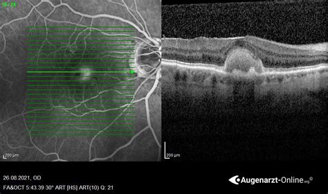 Adulte Vitelliforme Makuladegeneration AVMD Atlas Der Augenheilkunde