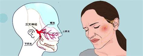 三叉神经痛常见药物及治疗效果 知乎