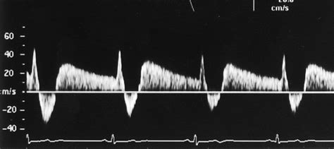 Vertebral Artery Doppler Waveform Changes Indicating Subclavian Steal | Sexiz Pix