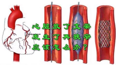 冠心病患者，心脏放了支架，出现了再狭窄，医生总结：三种解决方案！健康养生健康常识好看视频