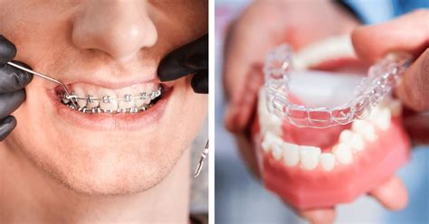 Invisalign Vs Braces Treatments How Are They Different