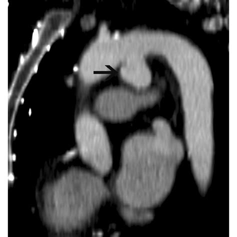 Fusiform Ascending Aortic Aneurysmsagittal Reconstructed CT Image In A