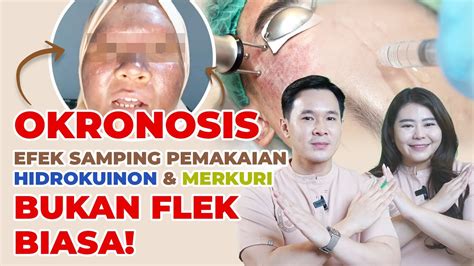 Okronosis Efek Samping Pemakaian Hidrokuinon Merkuri Beda Dengan