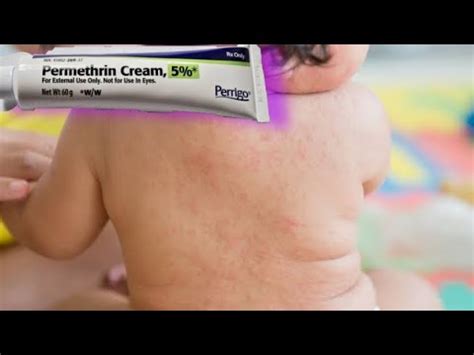 Cara Penggunaan Permethrin Untuk Mengatasi Scabies Pada Anak Youtube