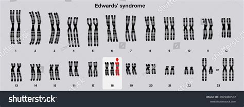 Sindrome De Edwards Imagens