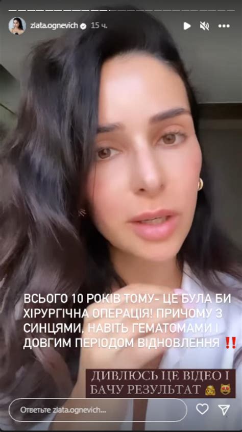 Злата Огнєвіч зняла на відео як їй роблять підтяжку обличчя Афіша Bigmir Net