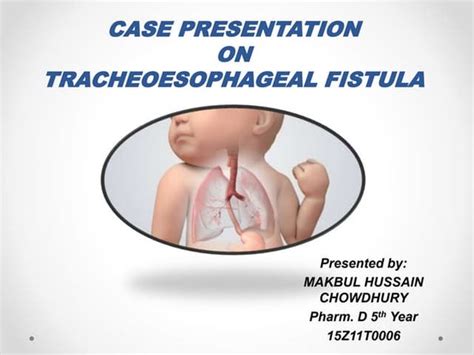 Tracheoesophageal Fistula