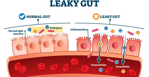 Leaky Gut What Is It And How To Fix It Higher Health