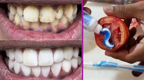 How To Turn Yellow Teeth Into White Fast In 2 Minutes Make Your