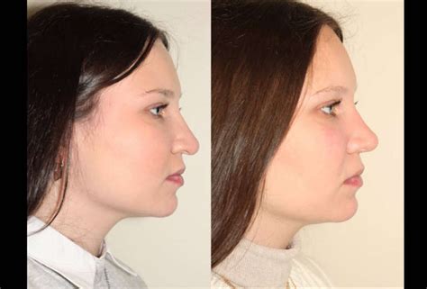 157 Rhinoplasty Dr Denton