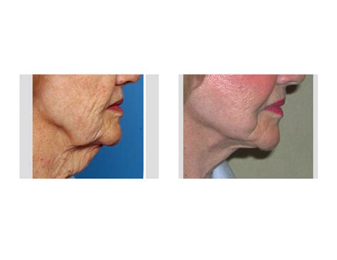 Facelift In Indianapolis Dr Barry Eppley Explore Plastic Surgery