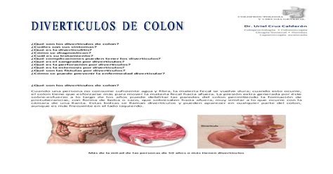 ¿qué Son Los Divertículos De Colon · ¿cómo Se Puede Prevenir La