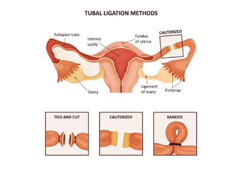 Tubal Reversal Surgery - PSFC