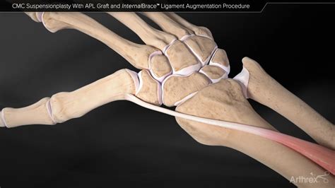 Arthrex Cmc Suspensionplasty With Apl Graft And Internalbrace