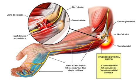La Compression Du Nerf Ulnaire Au Coude Centre Du Membre Superieur