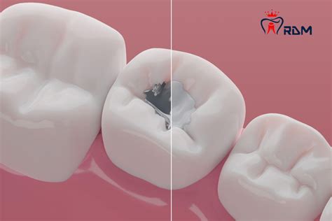 Amalgam VS Composite Fillings: Choosing The Right Dental Restoration