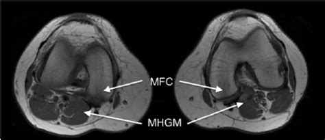 Popliteus Muscle Mri