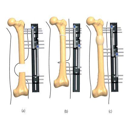 Femur Soft Tissue Treatments Orthofix Abs