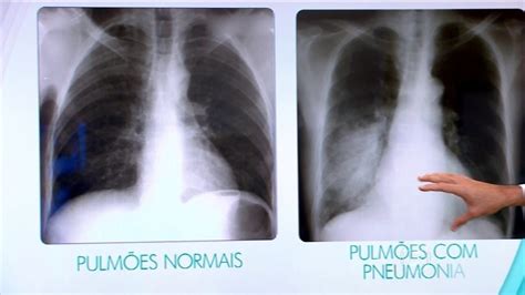 Pneumonia bacteriana entenda o que é as causas os sintomas e o