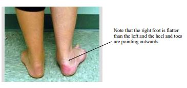 Royal Orthopaedic Hospital Adult Acquired Flat Foot Posterior Tibial