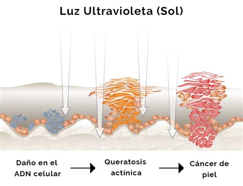 Queratosis actínicas Qué son y cómo eliminarlas