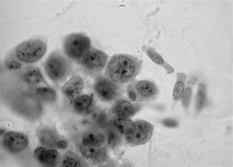 Diagnostic Lung Cytology Thoracic Key