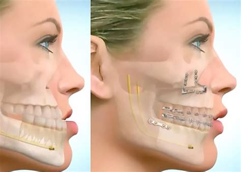 Maxillofacial Surgery Paideia International Hospital