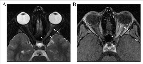 Optic Neuritis