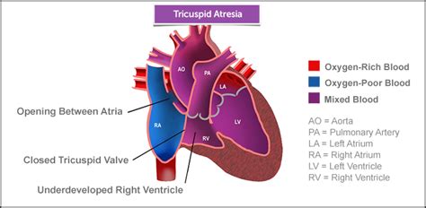 Tricuspid Atresia | Boston Children's Hospital