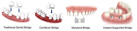 Dental Bridges London N1 | Dental Bridge Cost | Teeth Bridges Camden