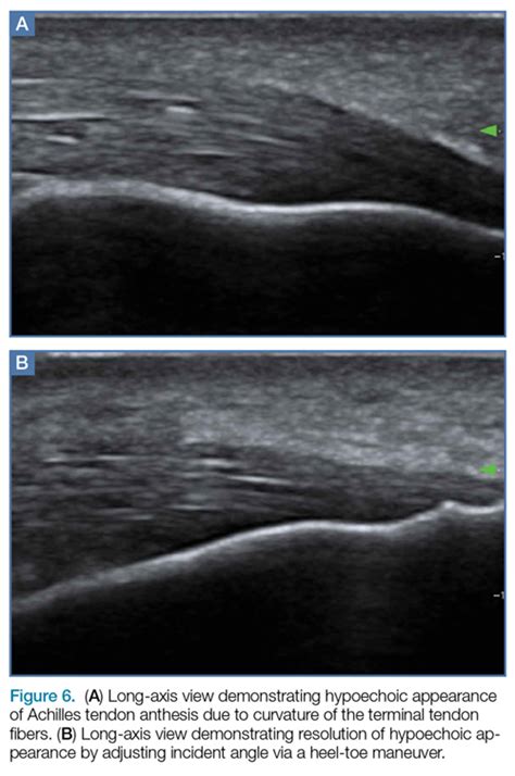 Emergency Ultrasound: Tendon Evaluation With Ultrasonography | MDedge ...